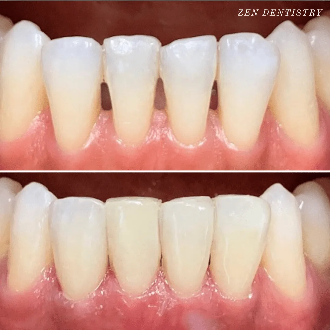 Before After 5 Before After 5