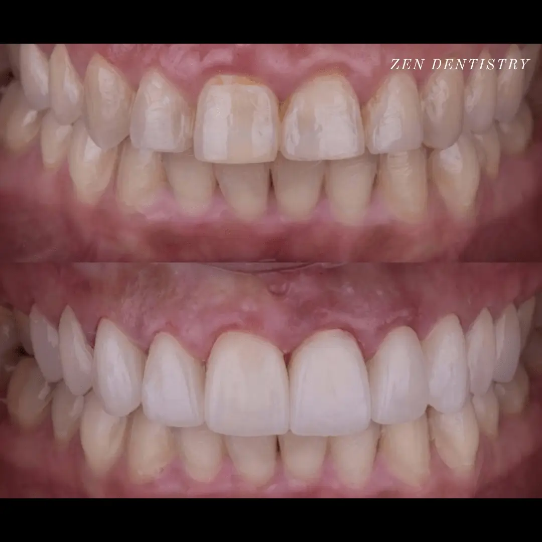 Before After 14 Before After 14