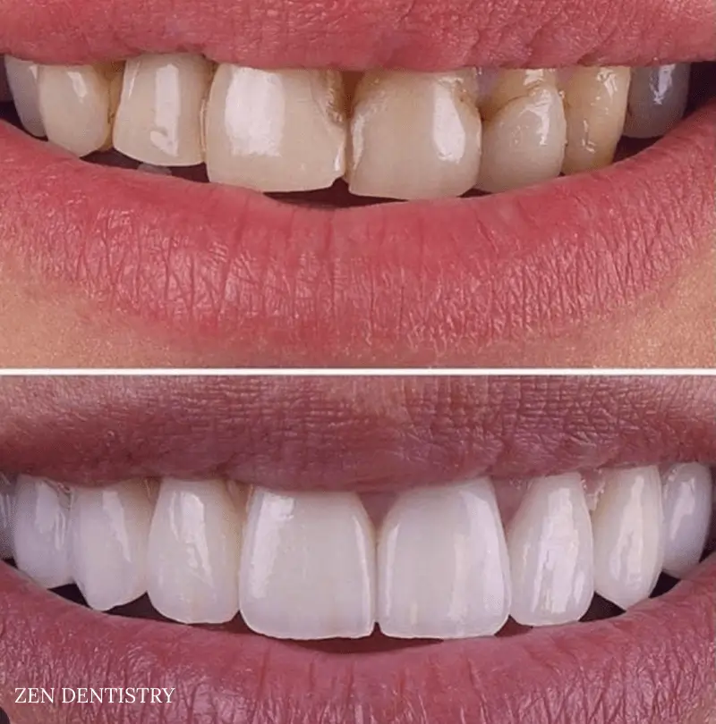 Before After 25 Before After 25