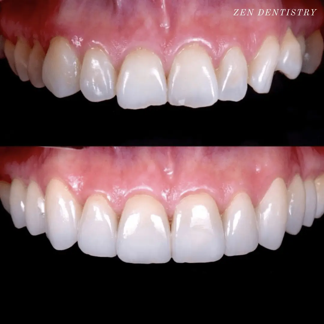Full mouth rehabilitation with porcelain veneers.