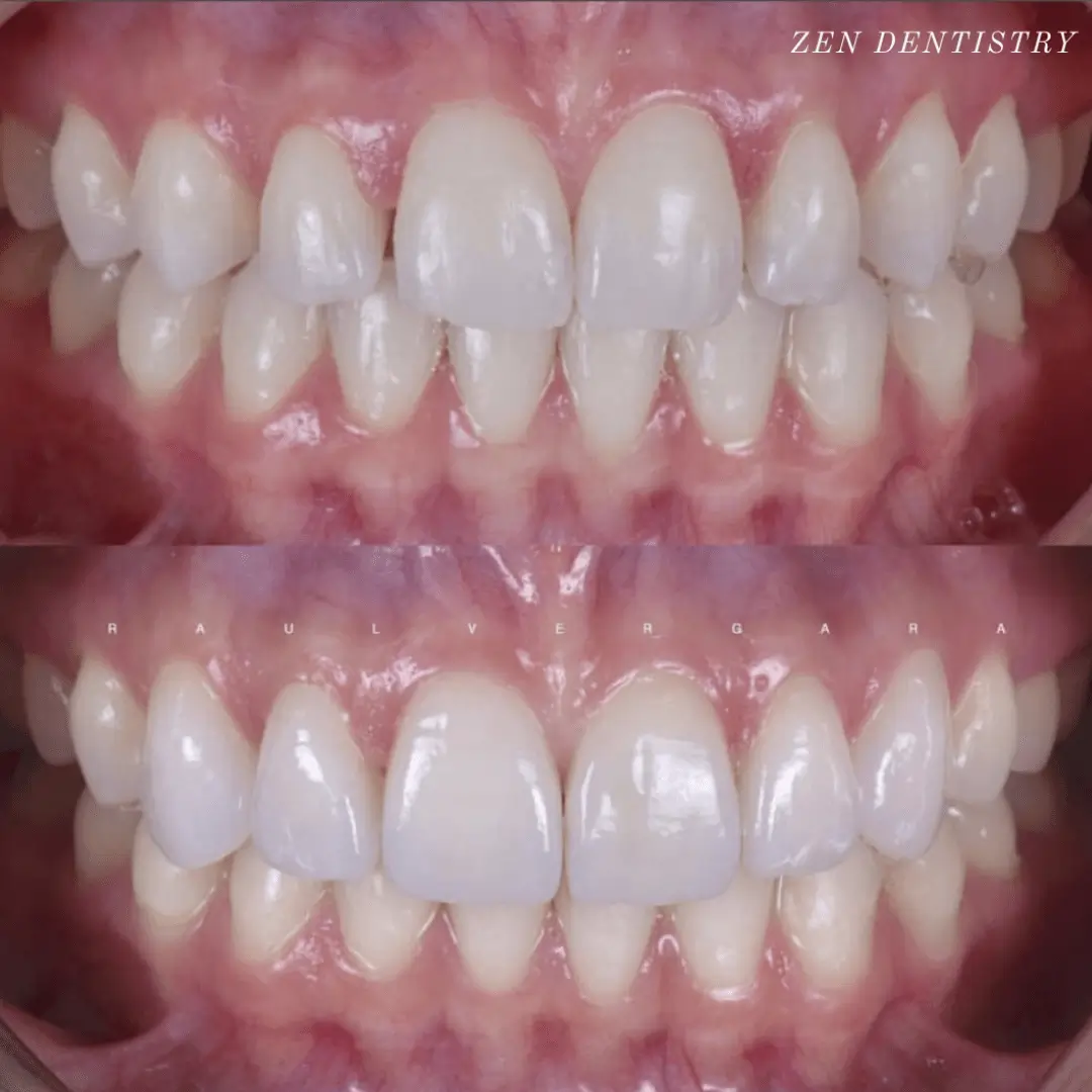 Upper six porcelain veneers