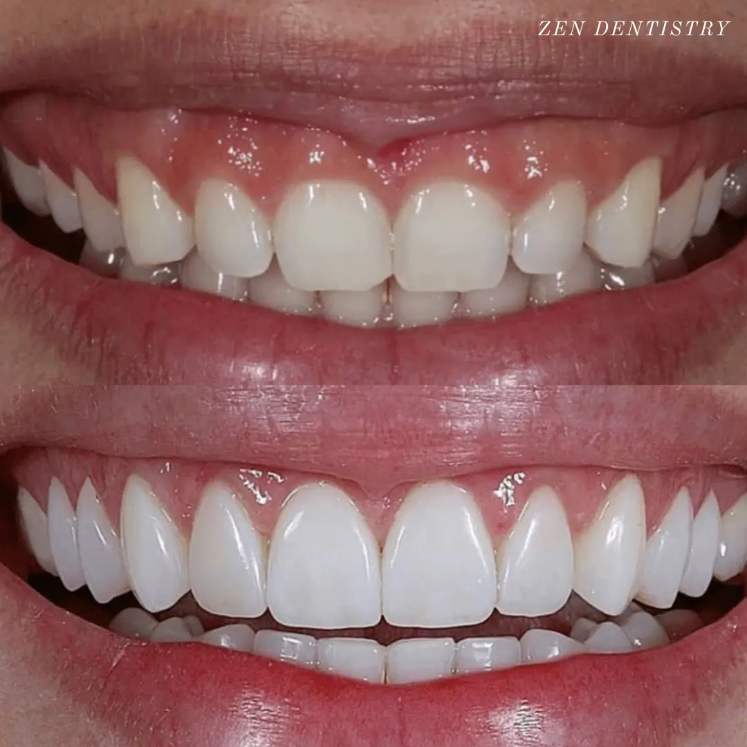 Gum lift with porcelain veneers