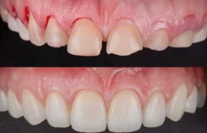 Smile design – A brief overview