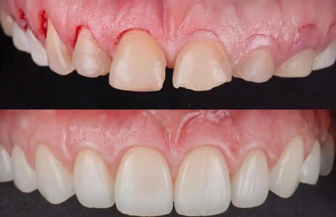 Smile design – A brief overview