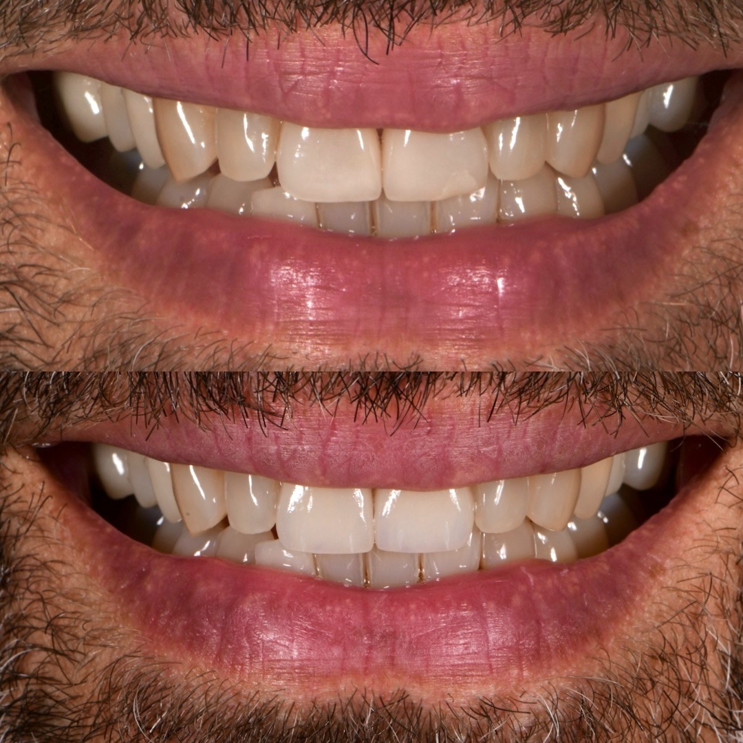 Upper central porcelain veneers