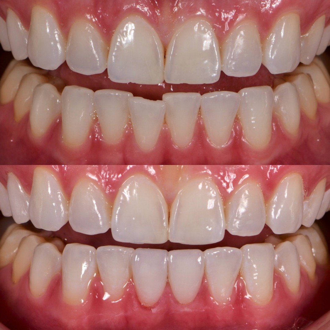 Lower veneers