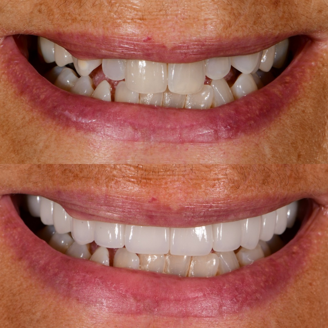 Upper porcelain veneers