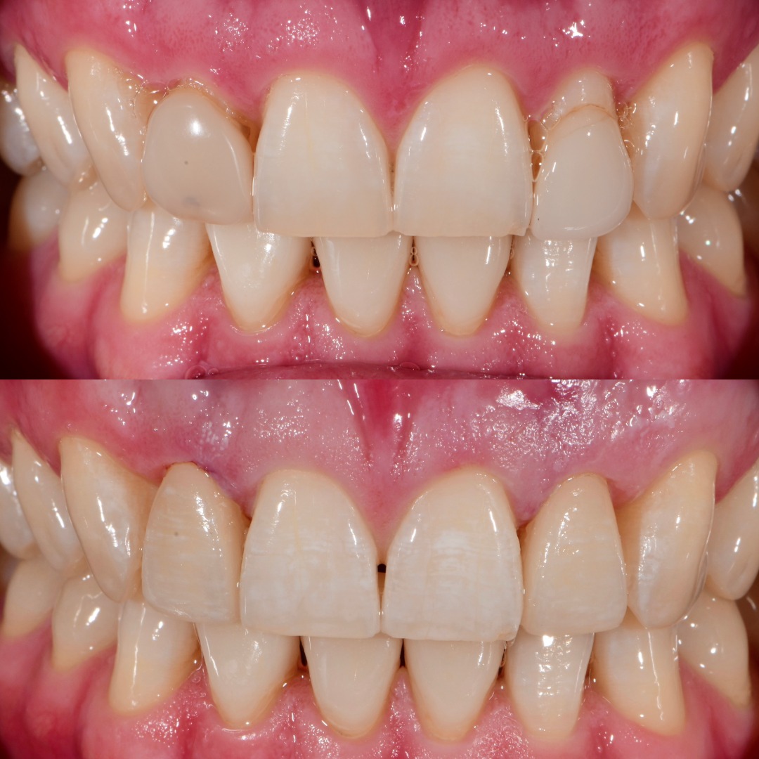 Upper lateral porcelain veneers