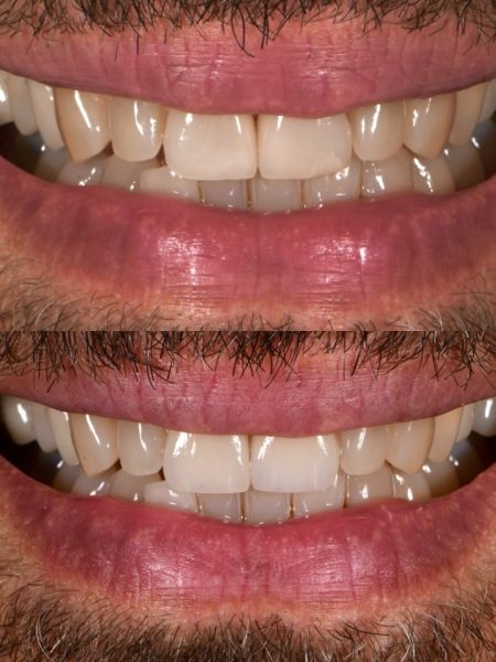 Upper central porcelain veneers