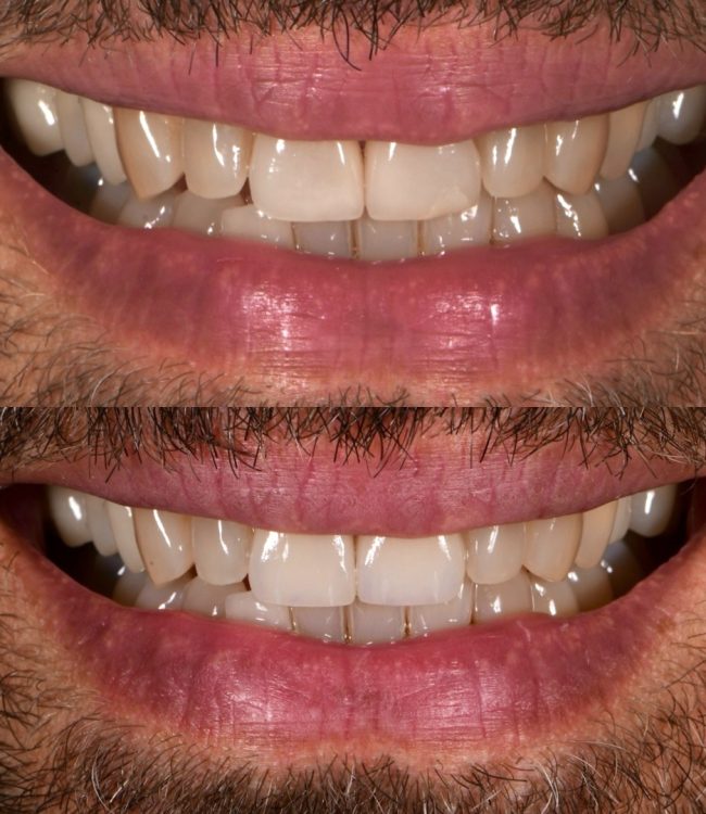 Upper central porcelain veneers