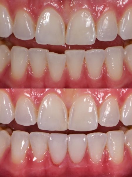 Lower veneers