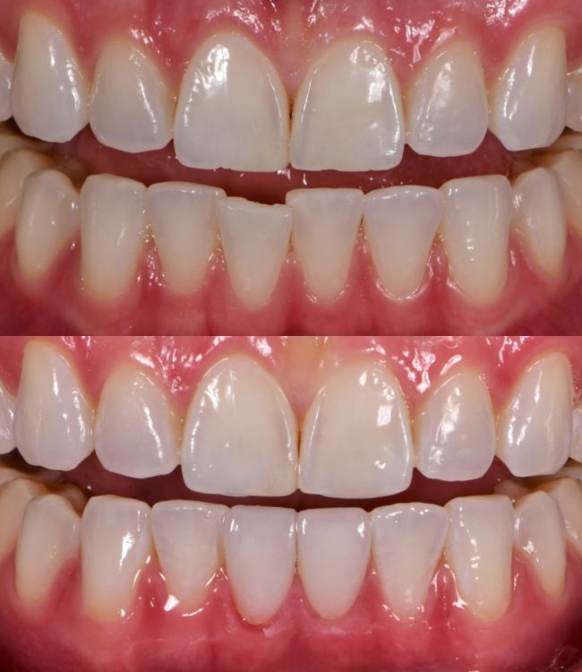 Lower veneers