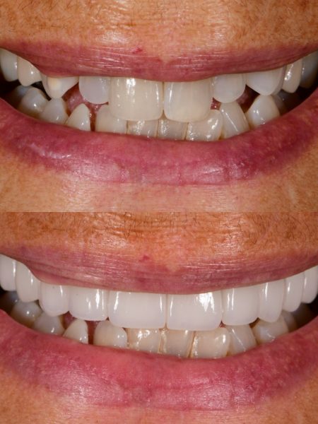 Upper porcelain veneers