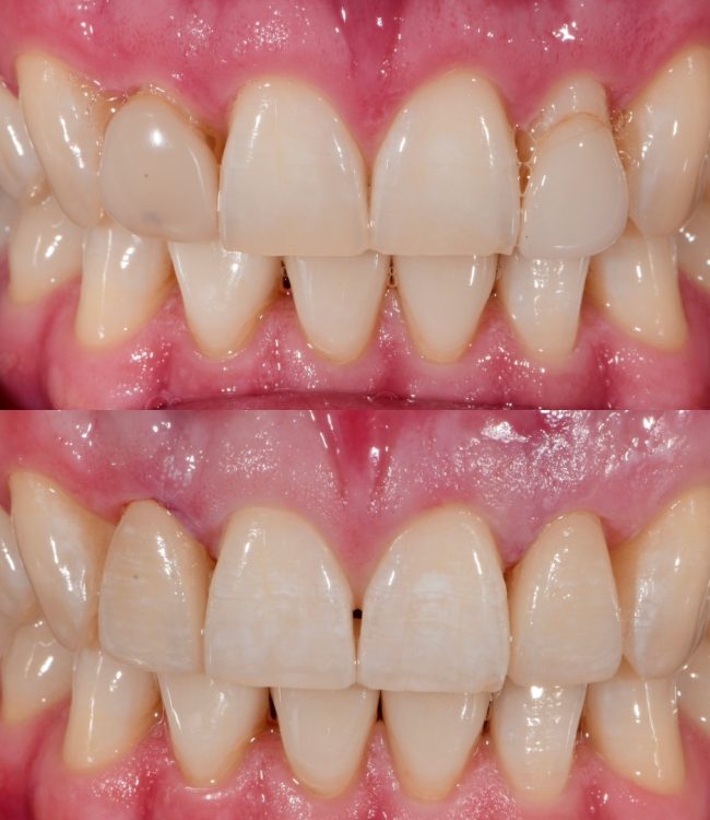 Upper lateral porcelain veneers