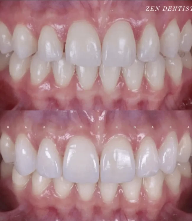 Upper six porcelain veneers